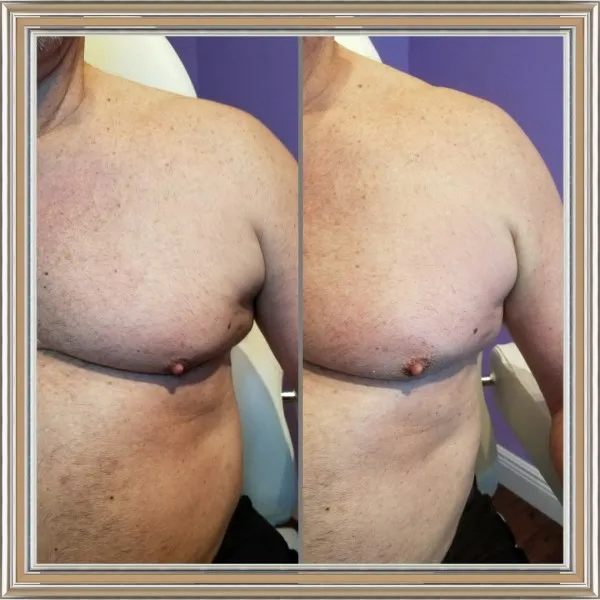 Before and after comparison of male torso showing body contouring results