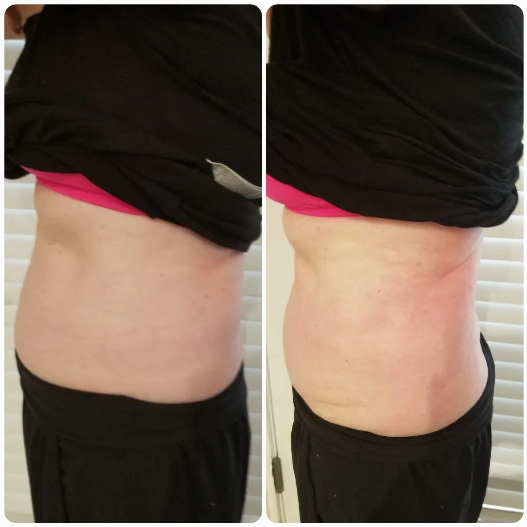 Before and after side view of torso showing reduced bloating and improved skin firmness