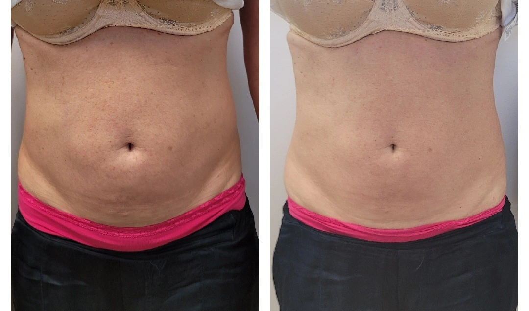 Before and after front torso view showing smoother, tighter abdominal contour