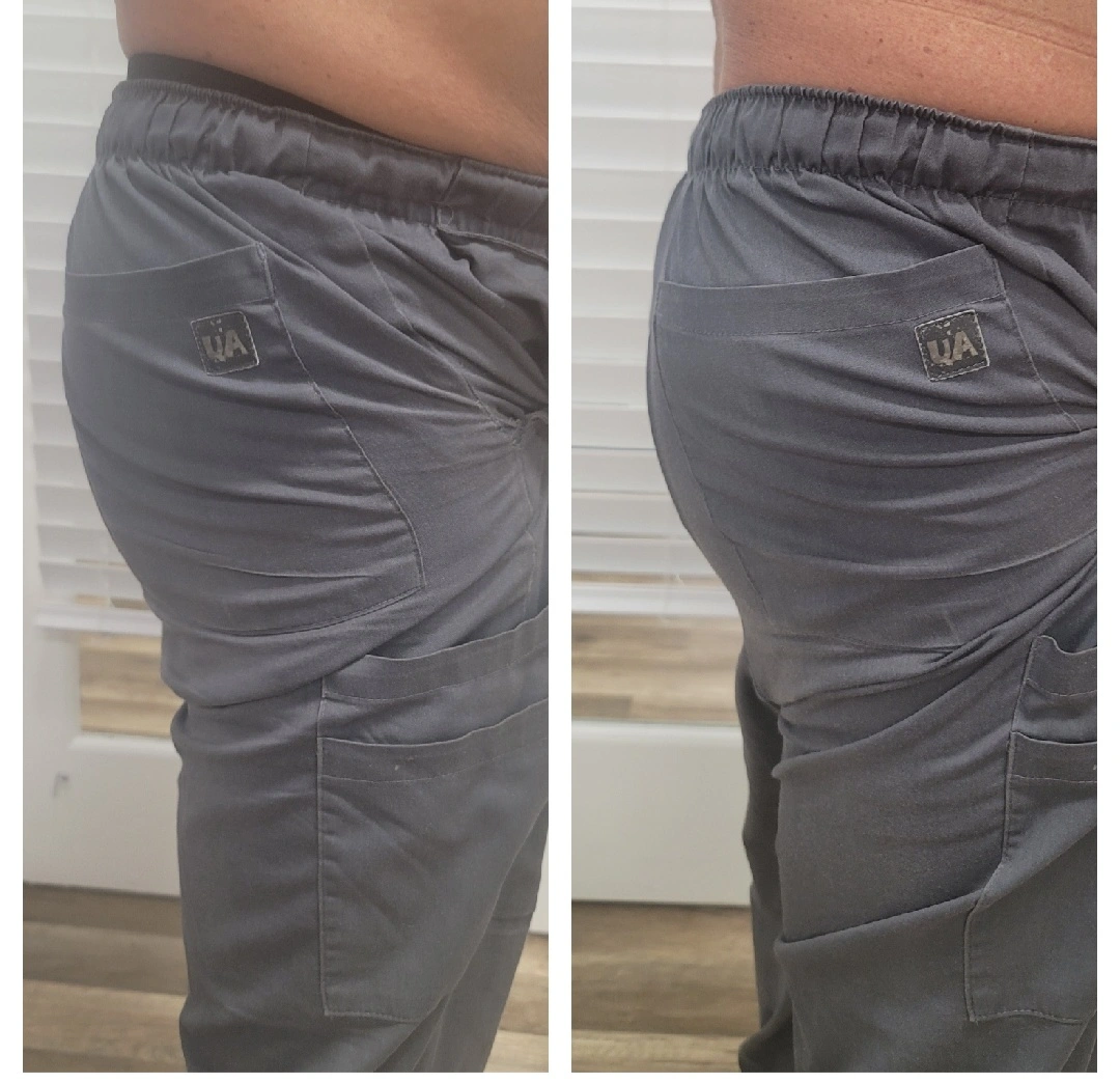 Before and after side view of thighs showing reduced appearance of cellulite