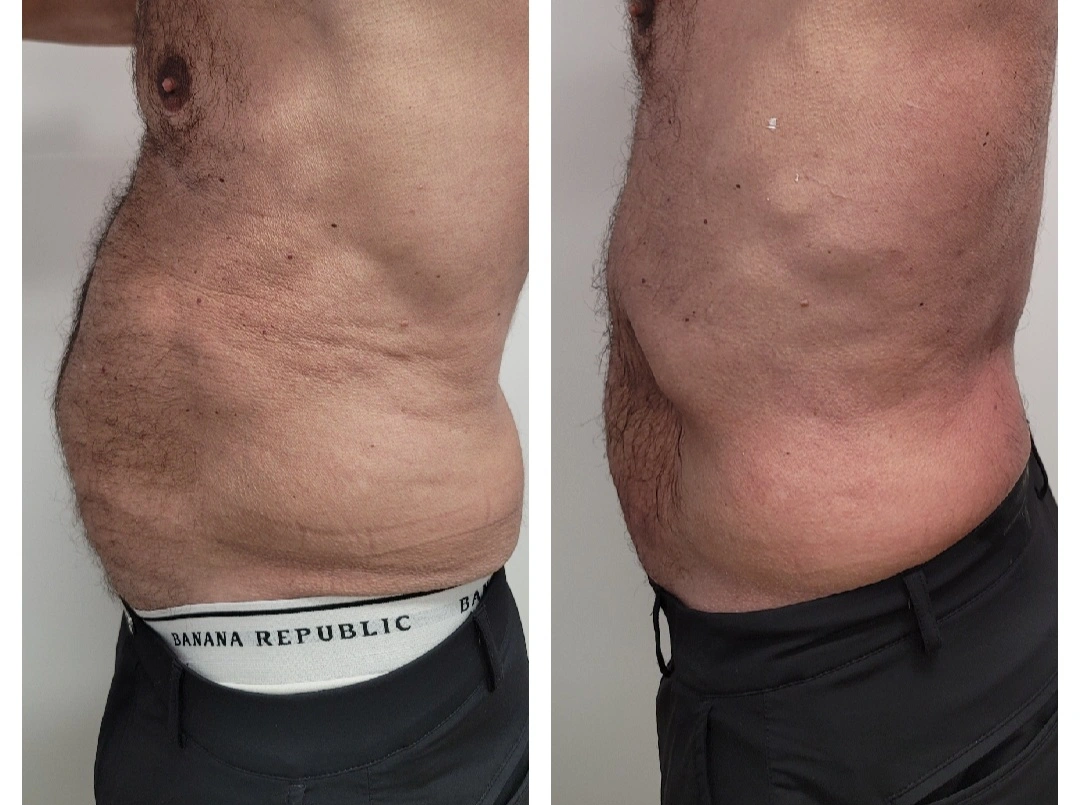 Before and after side-by-side abdominal comparison showing reduced body volume after treatment