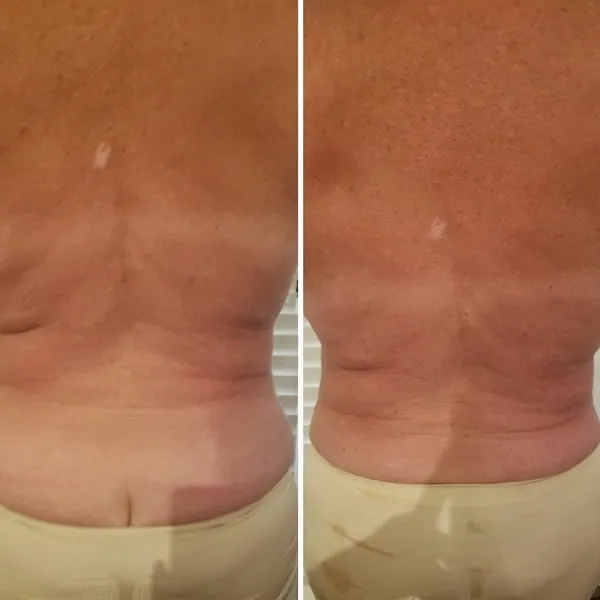 Before and after photos of back and flanks showing reduced contours