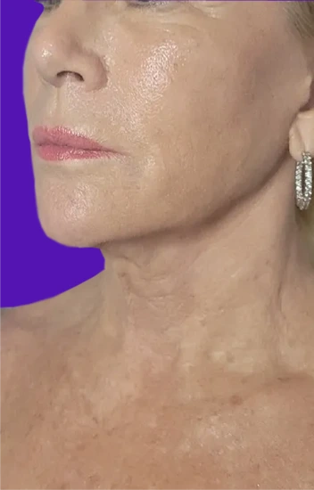 Facelift Before & After Banner