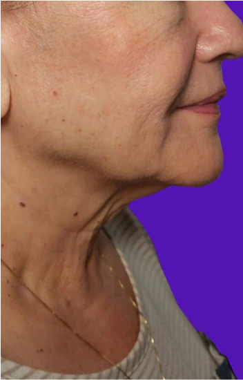 Facelift Before & After Banner
