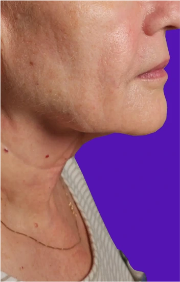 Facelift Before & After Banner