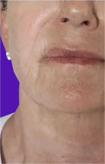 Facelift Before & After Banner