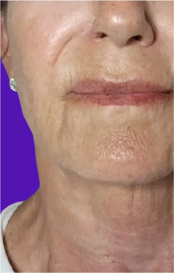 Facelift Before & After Banner