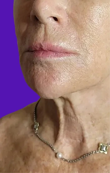 Facelift Before & After Banner