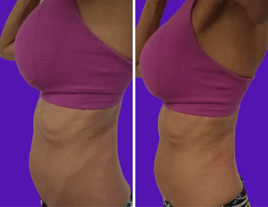 Before and after side-view comparison of body contouring results on torso and abdomen
