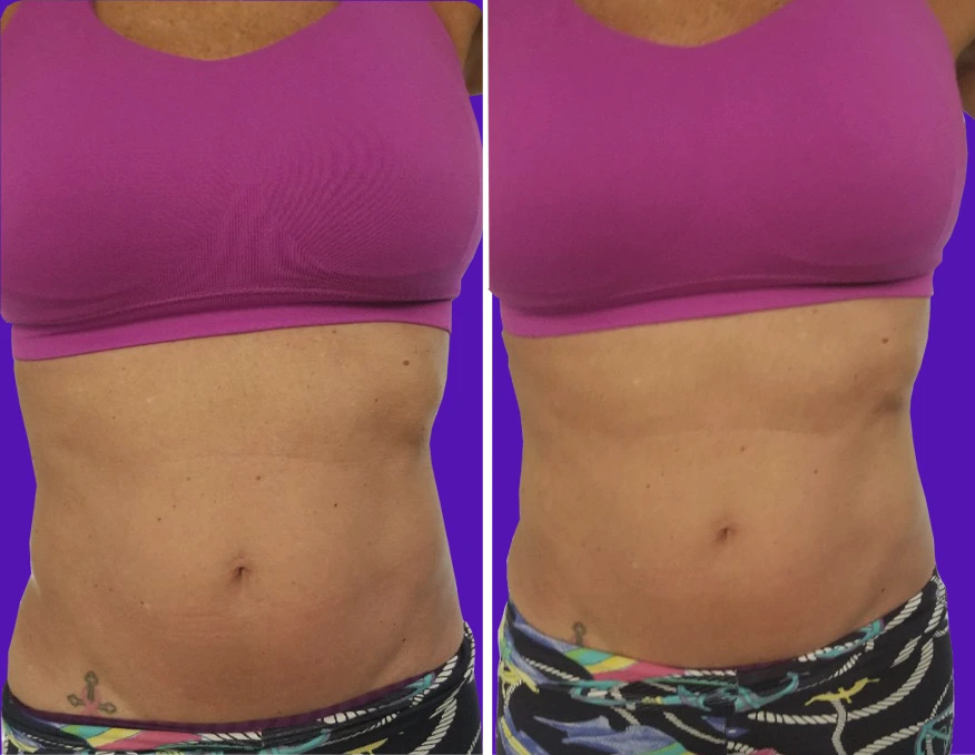Before and after comparison of abdominal contouring, showing firmer, more defined midsection