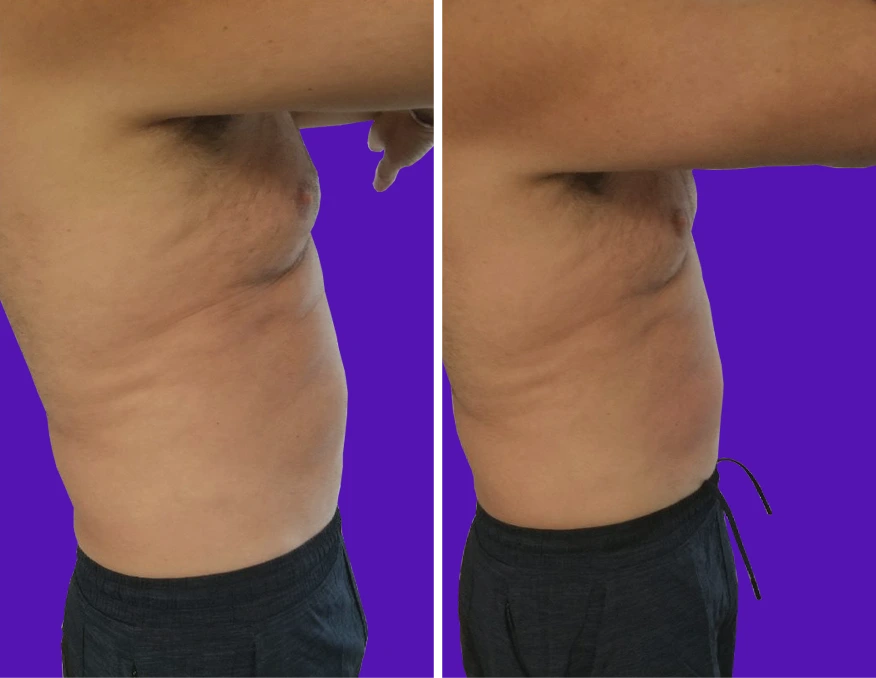 Before and after comparison of abdominal skin tightening, showing reduced laxity and improved contour
