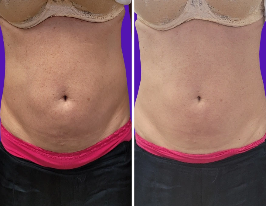 Before and after abdomen showing reduced skin laxity and improved skin texture