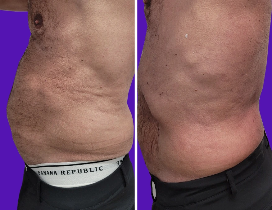 Before and after comparison of male abdomen with reduced laxity and improved definition