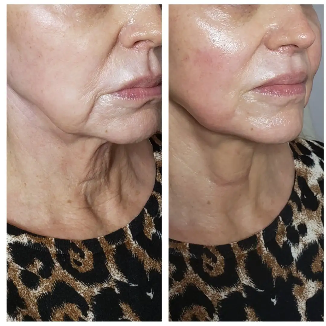 Before and after facial profile showing reduced sagging and improved jawline definition