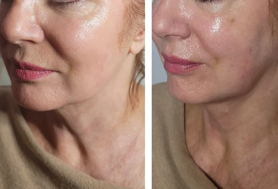 Before and after side profile showing improved skin texture and reduced nasolabial folds