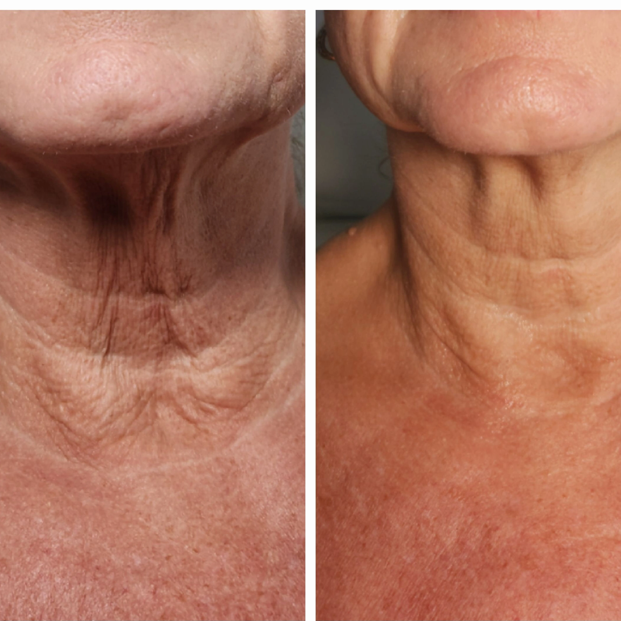 Before and after closeup of neck showing reduced wrinkles and improved skin tightness