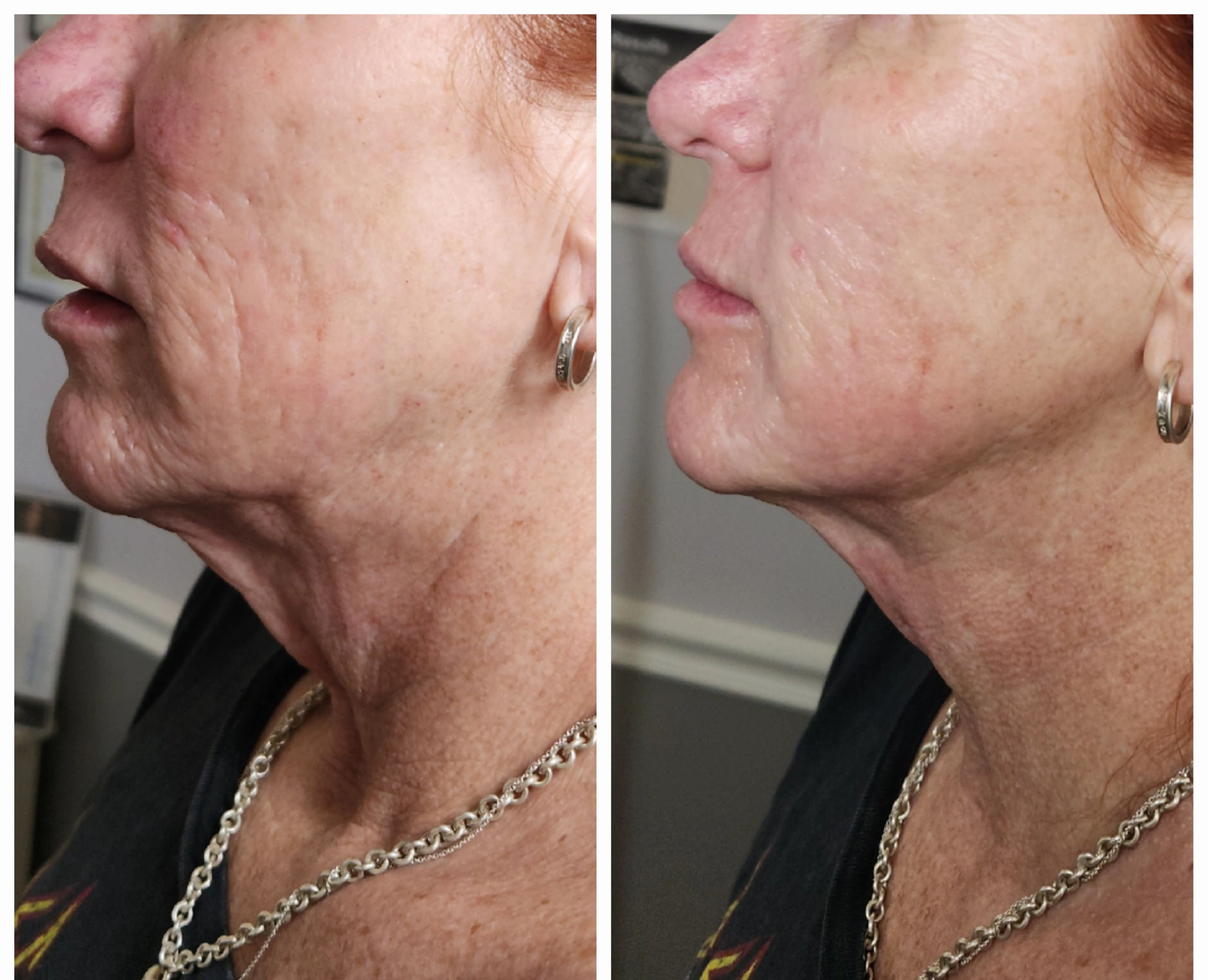 Before and after side profile showing improved jawline definition and reduced jowling