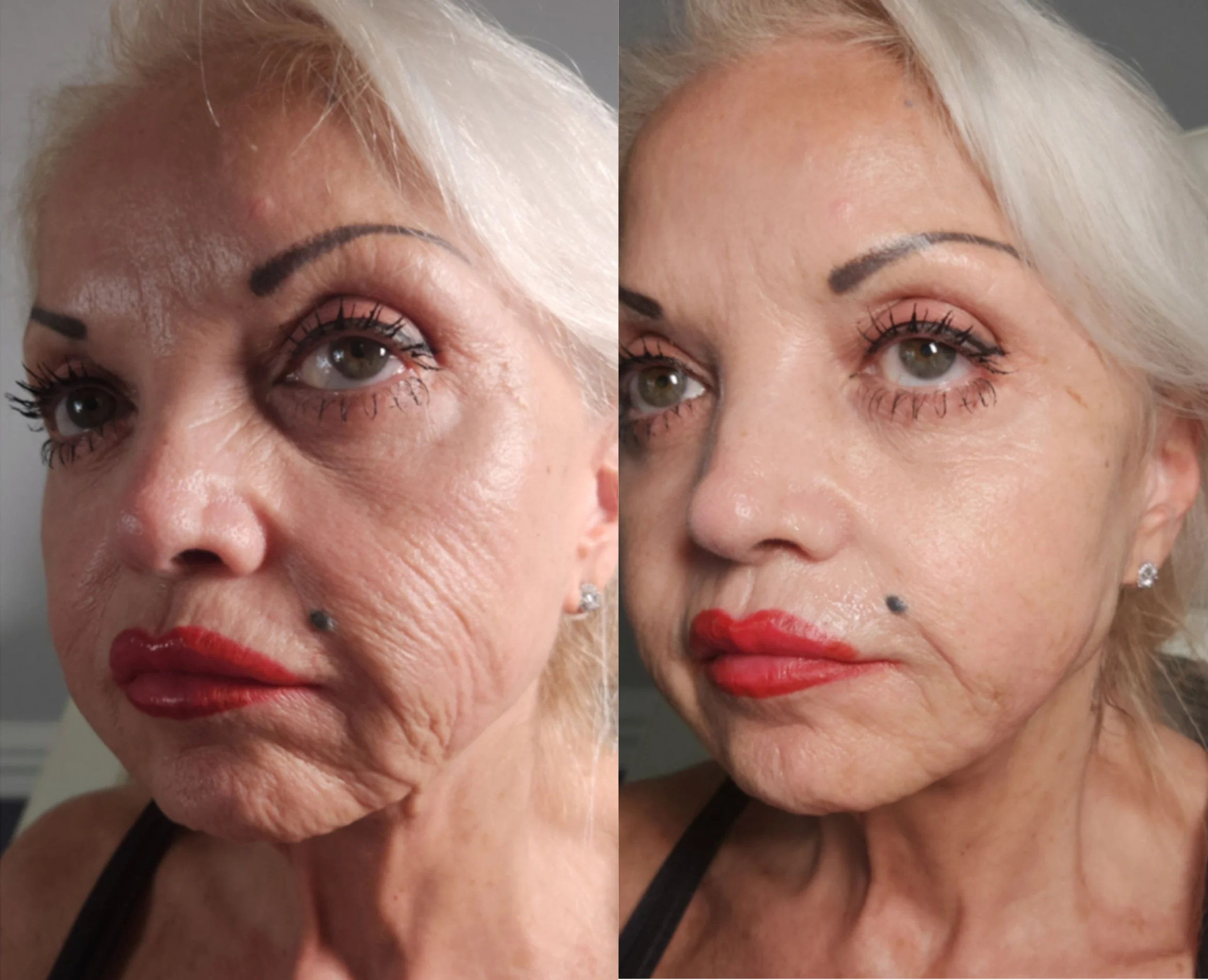 Before and after facial comparison showing smoother skin and reduced wrinkles around mouth and eyes