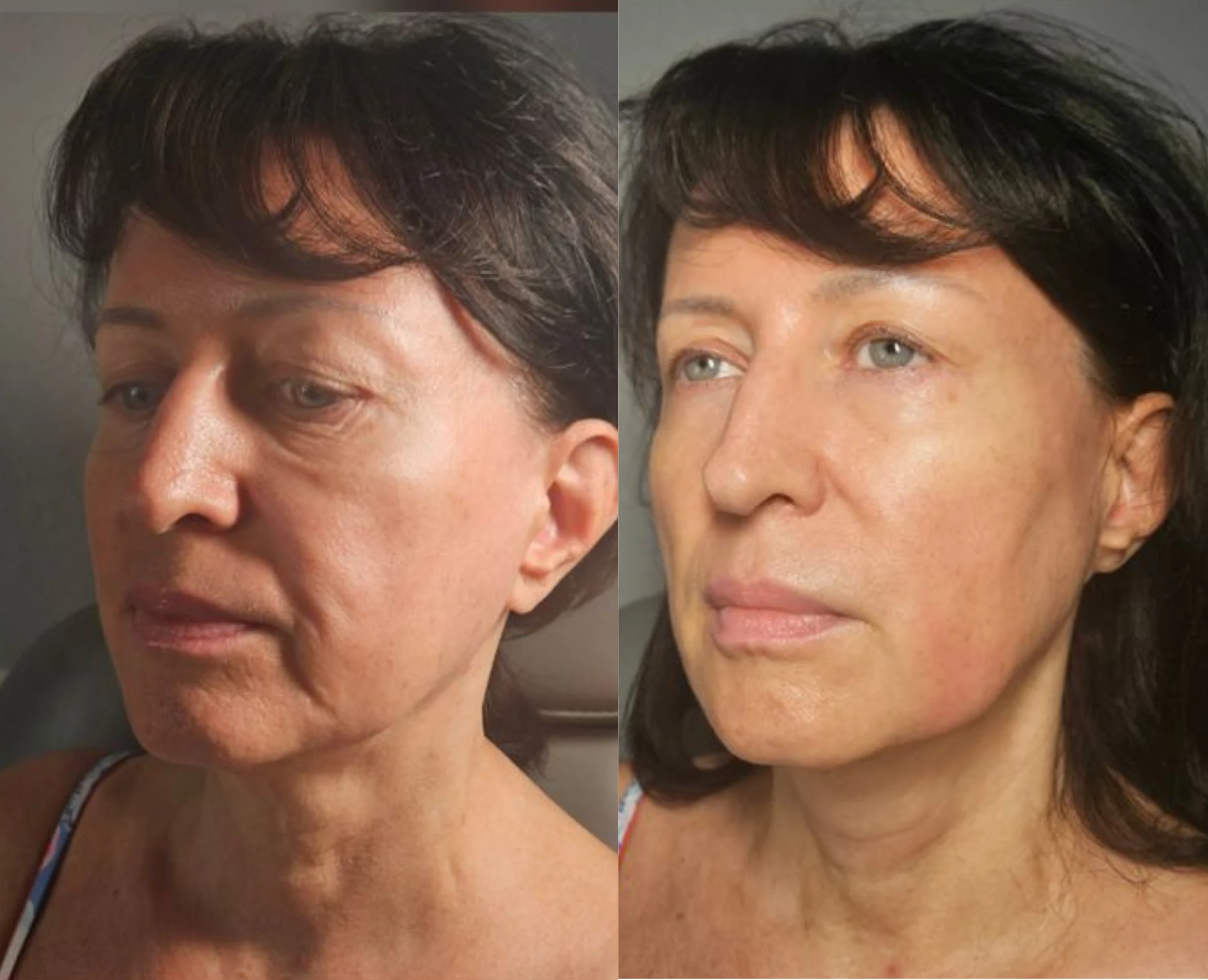 Before and after facial profile comparison showing reduced wrinkles and improved skin texture