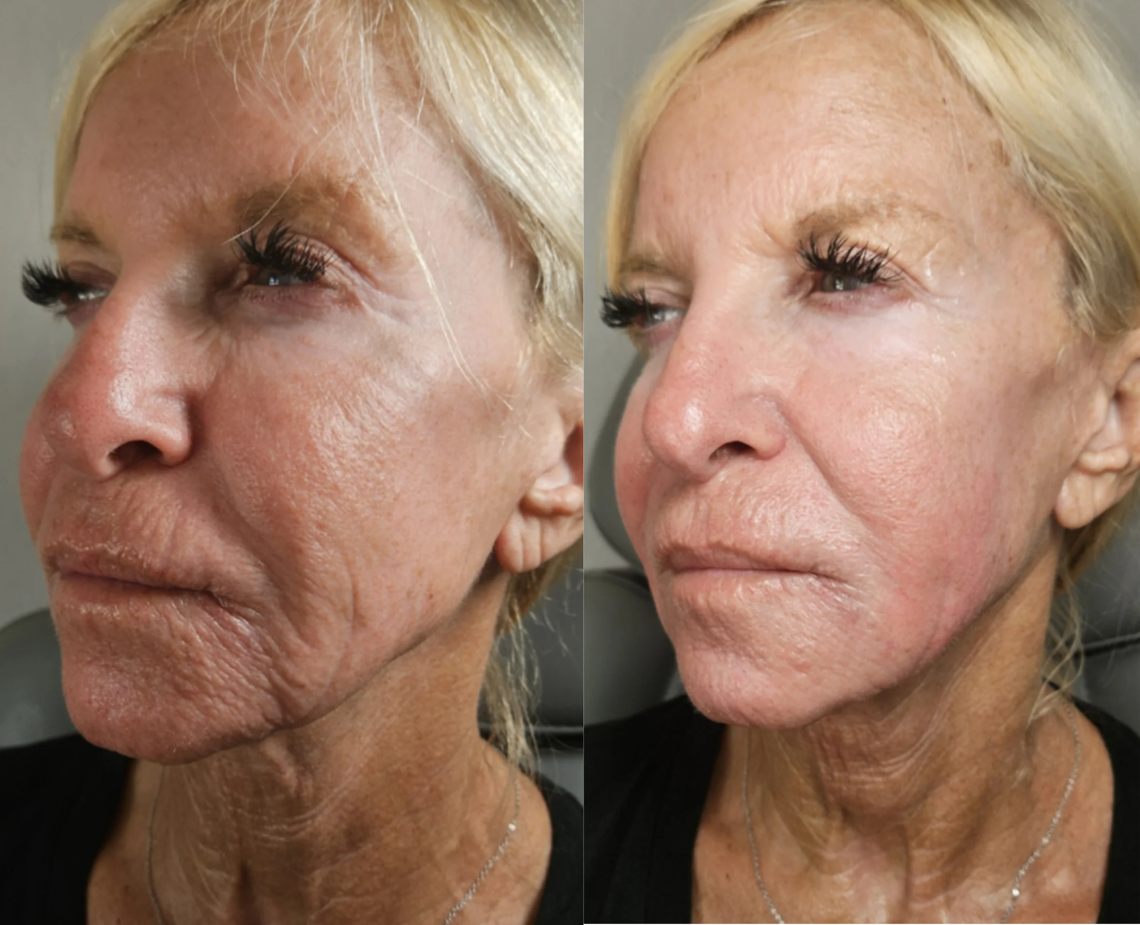 Before and after profile comparison showing improved skin firmness and reduced facial lines
