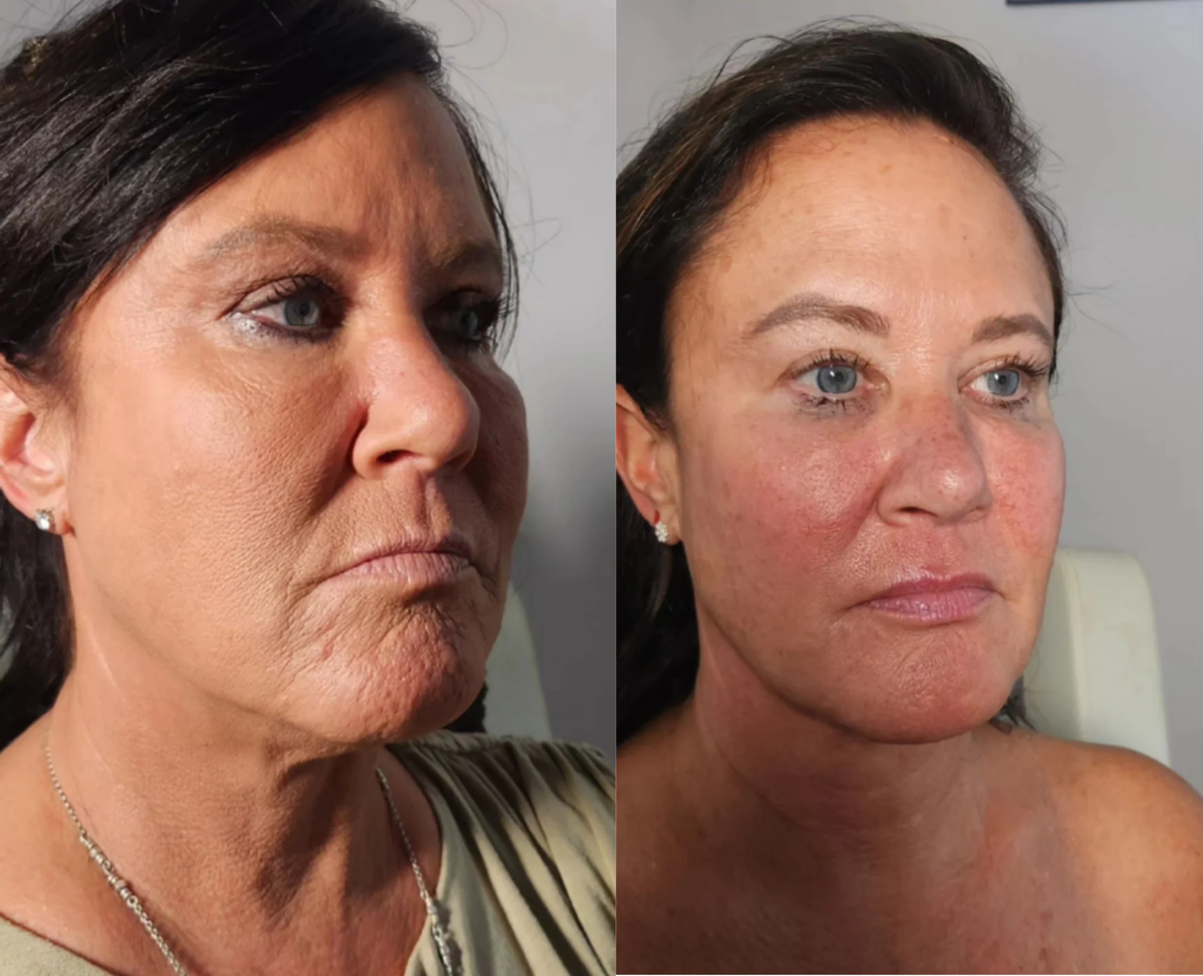 Before and after side profile showing improved jawline definition and skin rejuvenation
