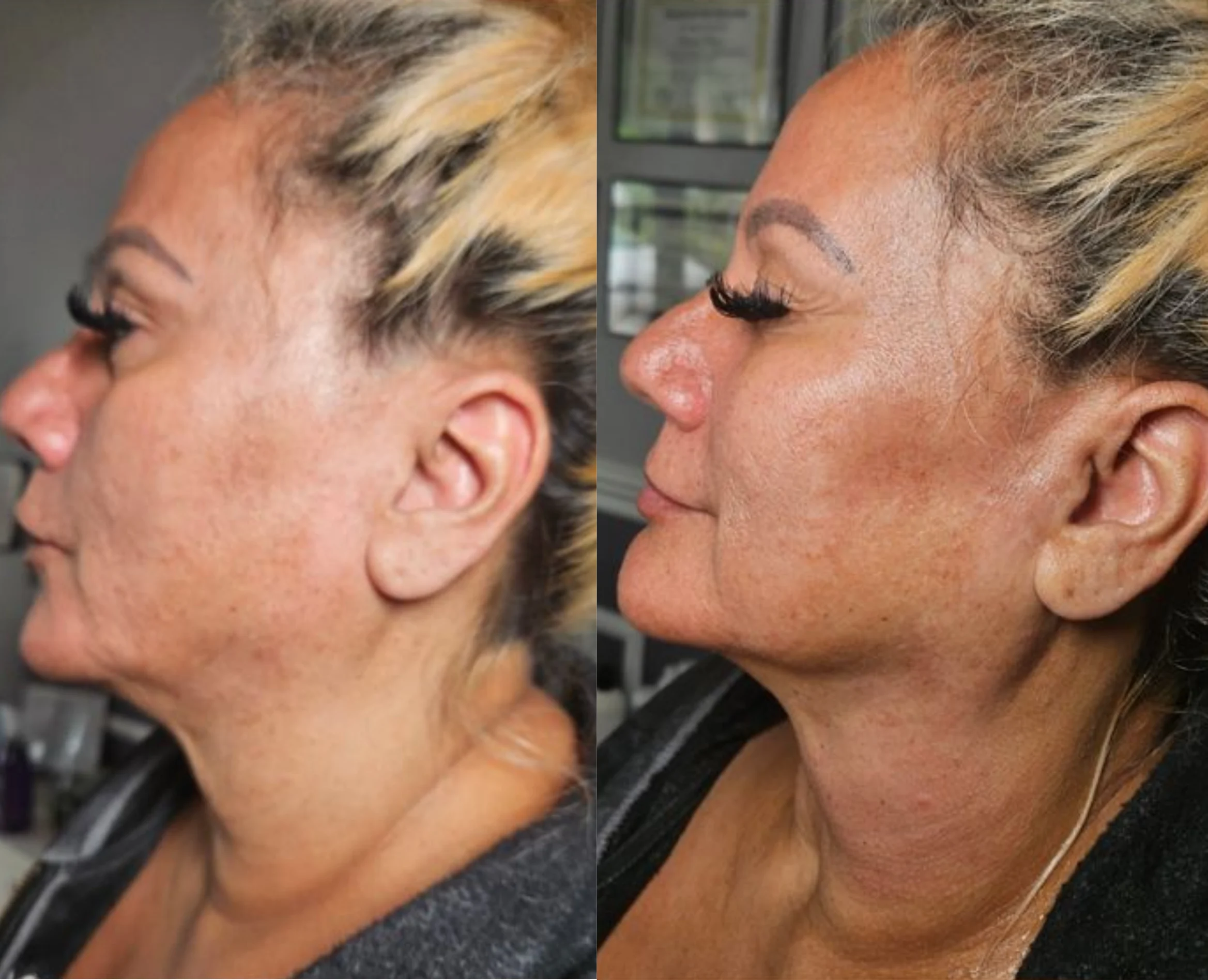Before and after profile comparison showing facial rejuvenation results
