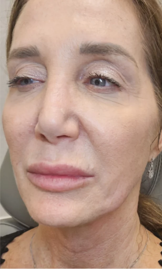 Woman's frontal view showing reduced under-eye wrinkles and forehead lines