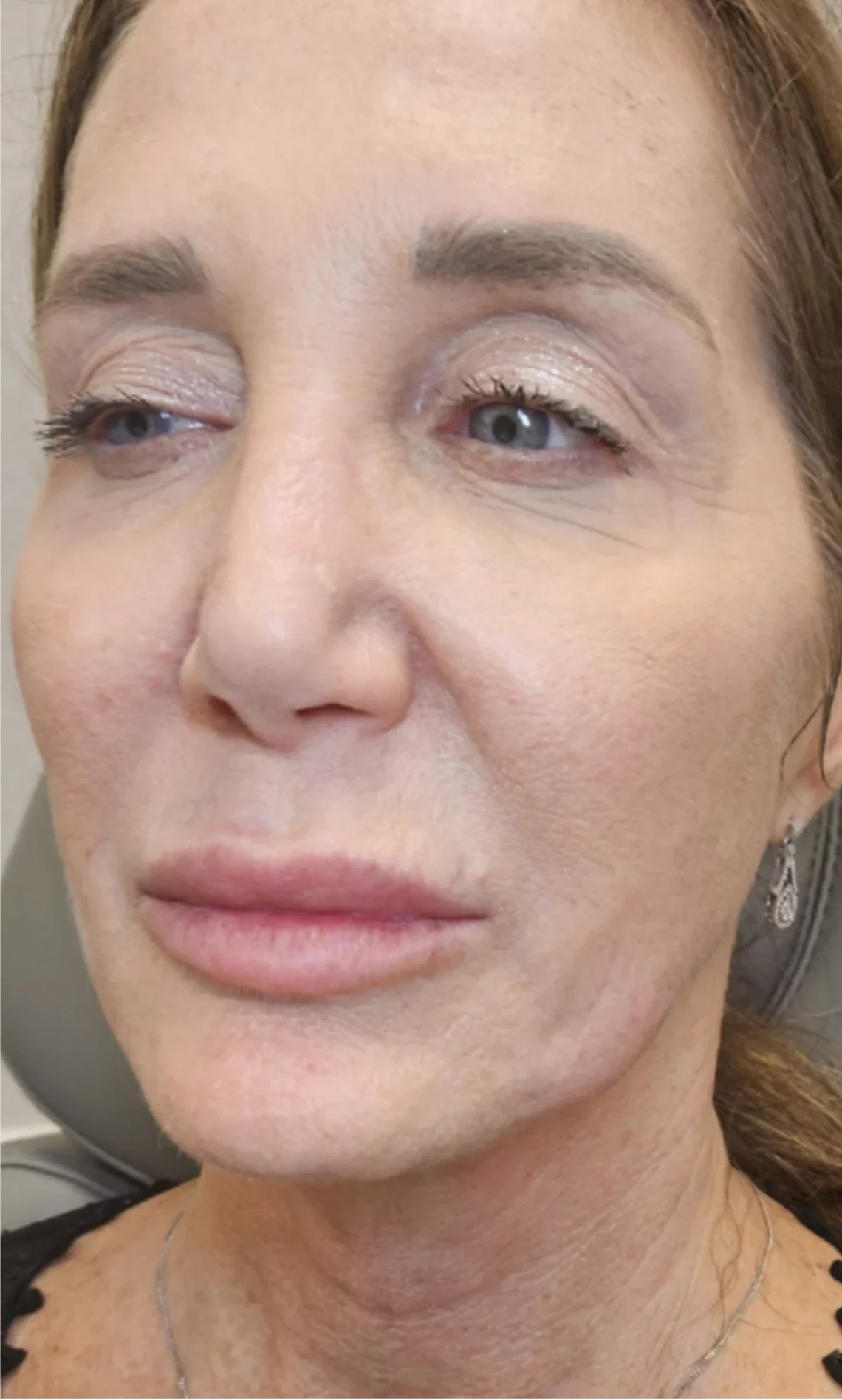 Woman's face showing forehead and eye area with fine lines and wrinkles