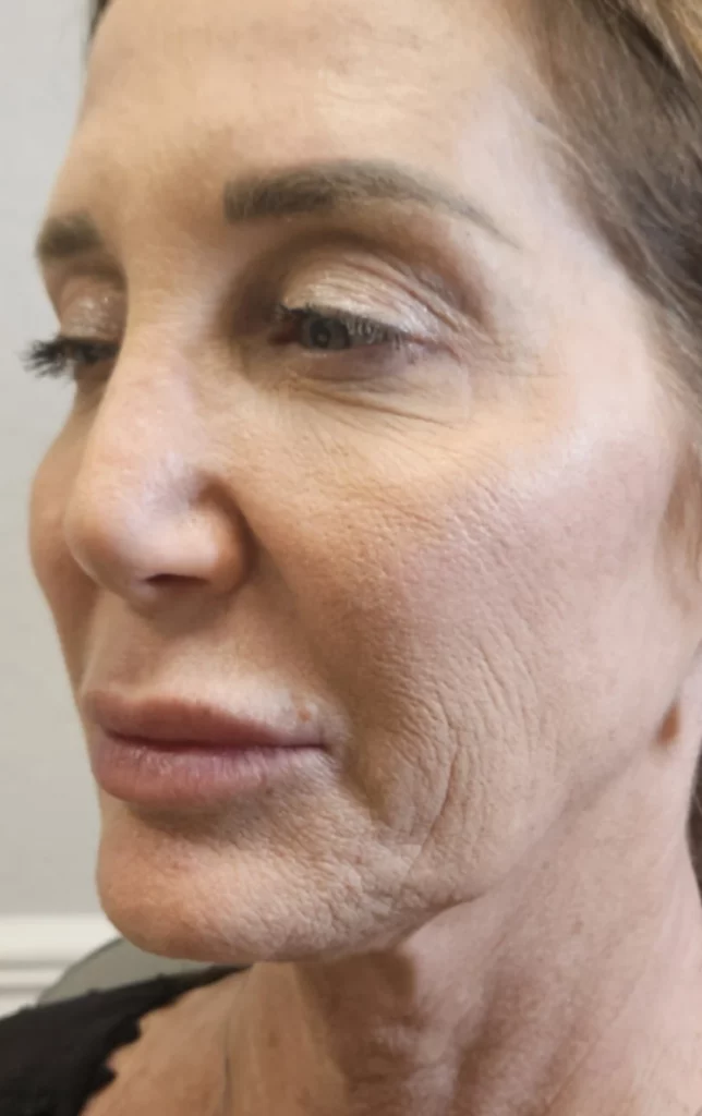 Woman's profile showing smoother skin texture after anti-aging treatment