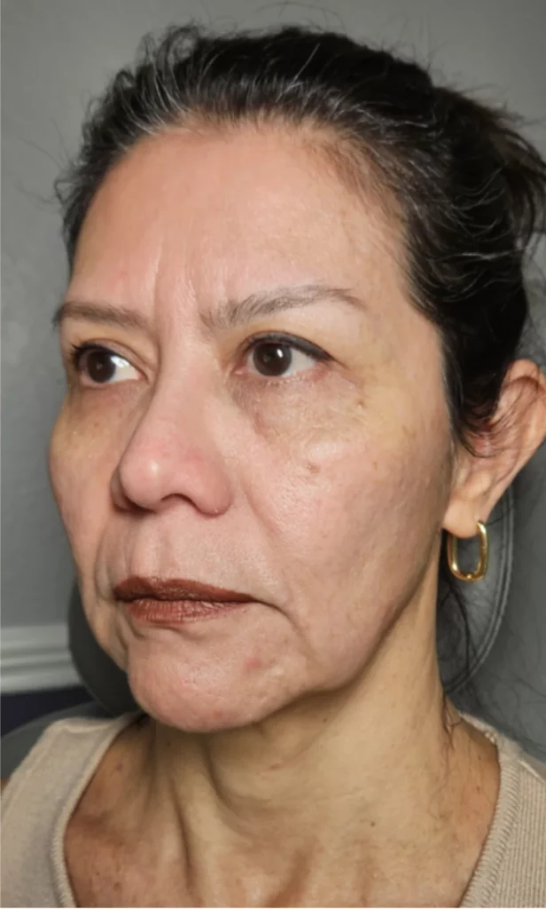 Woman's three-quarter view showing improved skin tone and reduced facial lines