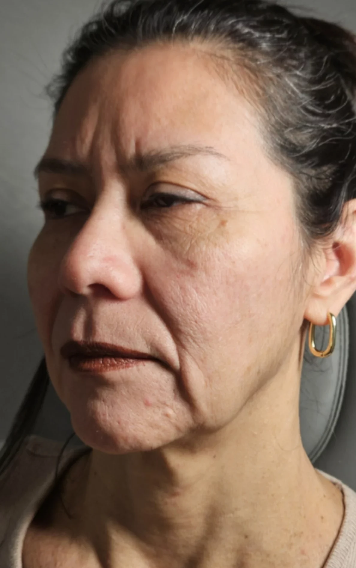 Woman's profile showing facial lines and wrinkles before treatment
