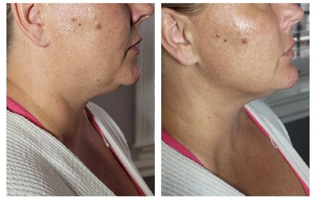 Before and after side profile comparison showing improved jawline definition