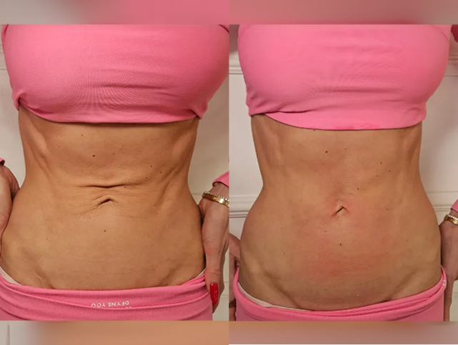 Before and After Gallery: Non-Surgical Post Weight Loss Skin Tightening