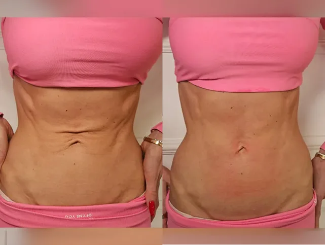 Before and After Gallery: Non-Surgical Post Weight Loss Skin Tightening