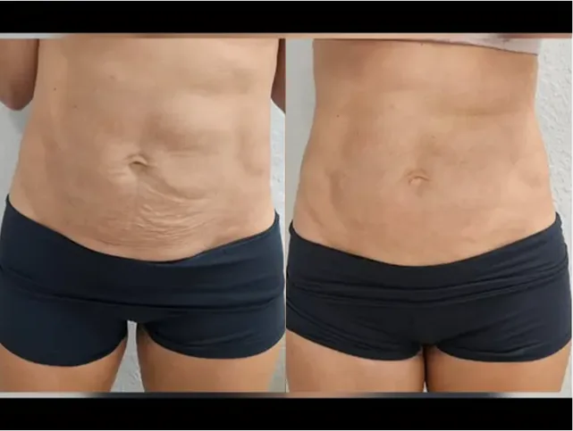 Before and After Gallery: Non-Surgical Post Weight Loss Skin Tightening