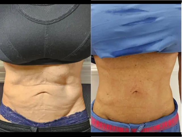 Before and After Gallery: Non-Surgical Post Weight Loss Skin Tightening