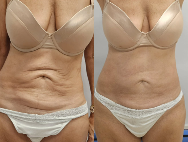 Before and After Gallery: Non-Surgical Post Weight Loss Skin Tightening