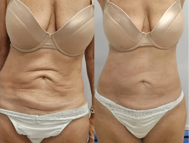 Before and After Gallery: Non-Surgical Post Weight Loss Skin Tightening