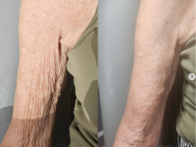 Before and After Gallery: Non-Surgical Post Weight Loss Skin Tightening