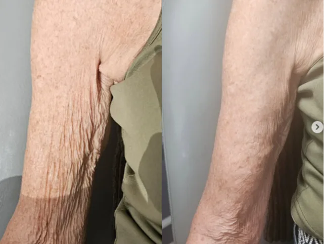 Before and After Gallery: Non-Surgical Post Weight Loss Skin Tightening