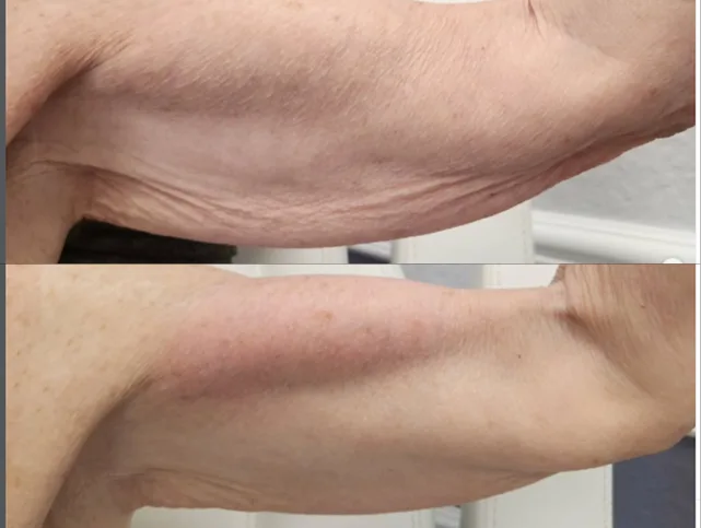 Before and After Gallery: Non-Surgical Post Weight Loss Skin Tightening