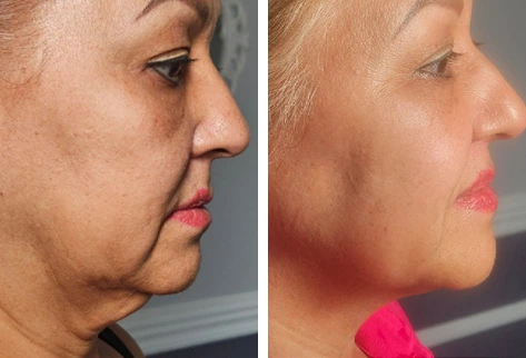 Before and after non-surgical facelift results showing improved jawline definition and skin tightness