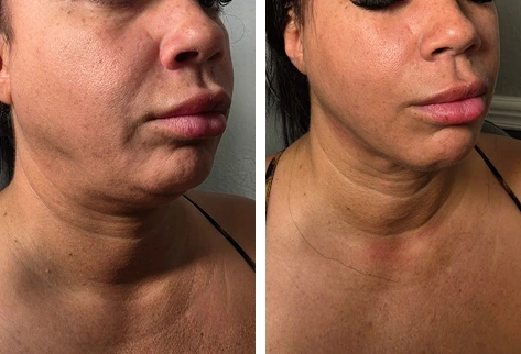 Before and after non-surgical facelift results showing improved jawline definition and skin tightness