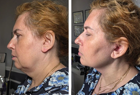 Before and after profile views of a non-surgical facelift patient showing improved jaw definition and skin tightness
