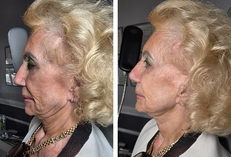 Before and after side profile comparison of a non-surgical facelift patient showing improved skin firmness and contour