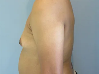 Patient's torso before procedure, side view showing chest profile