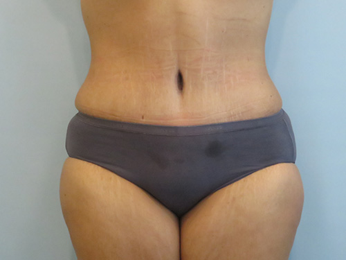 Tummy Tuck | 360 Body Lift Before and After case 1