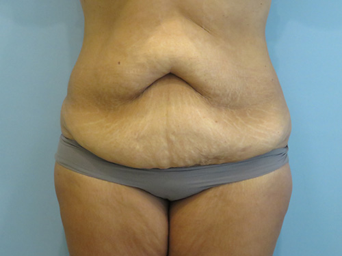 Tummy Tuck | 360 Body Lift Before and After case 1