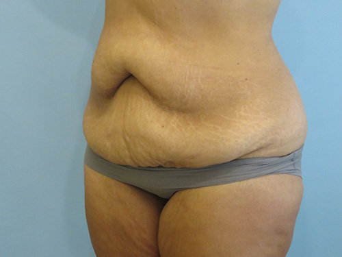 Tummy Tuck | 360 Body Lift Before and After case 1