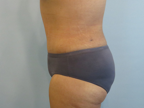 Tummy Tuck | 360 Body Lift Before and After case 1